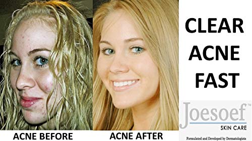 JOESOEF SKIN CARE Sulfur Soap Acne Facial Cleanser Anti Acne Sulfur Soap 100G 4 Pack