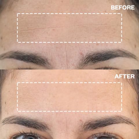 Wrinkles Schminkles Forehead Wrinkle Patches - Reusable Silicone Smoothing Pads For Brow Lift, Wrinkle Smoothers, Reduce Frown L