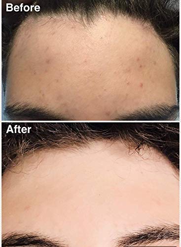 Teenology Shampoo for Teens - Avoid Forehead and Body Acne - No Sulfates or Parabens, Noncomedogenic, Natural Botanical Extracts