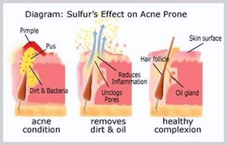JOESOEF SKIN CARE Sulfur Soap Acne Facial Cleanser Anti Acne Sulfur Soap 100G 4 Pack