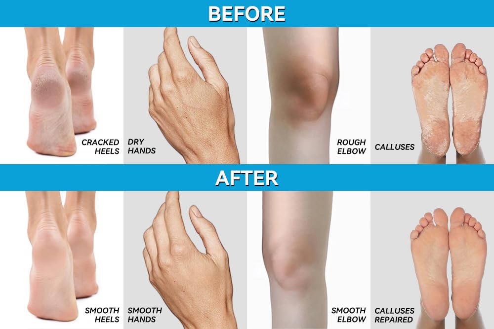 CLEAR Urea Cream 40% + 1% Hyaluronic Acid (4oz) | Softens Cracked Heels & Dry Skin Urea Cream 40 Percent - Infused w Tea Tree &