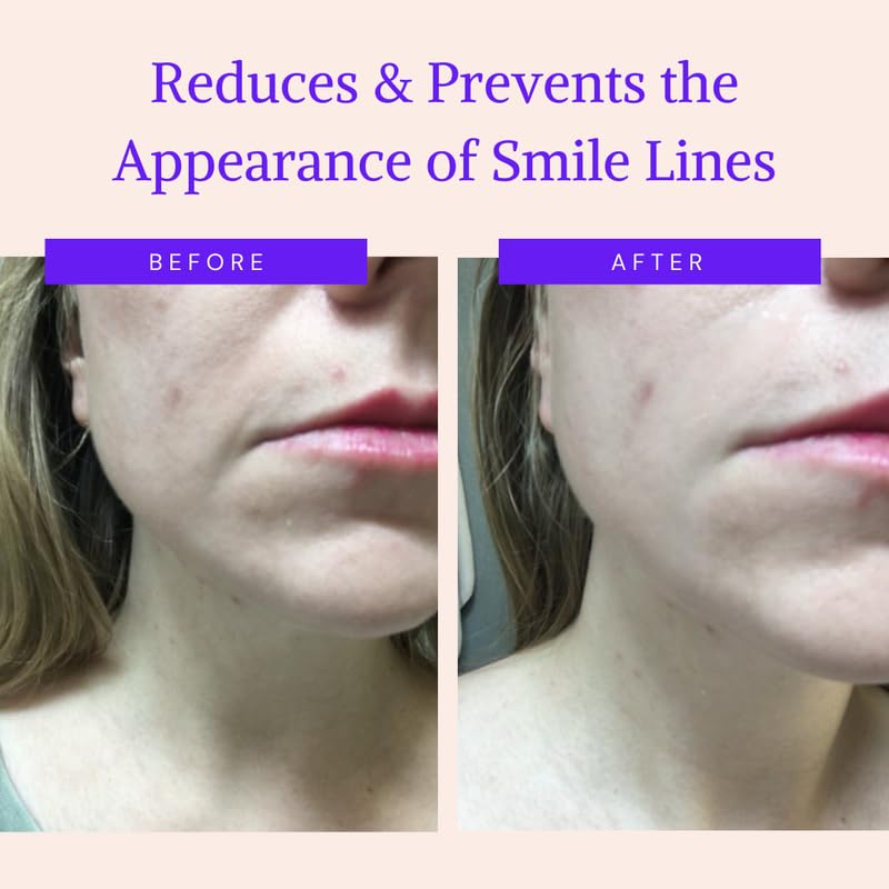 Blumbody Face Wrinkle Patches - Anti Wrinkle Facial Patches To Smooth Smile Lines - Non-Silicone Face Patches Wrinkles Tape For