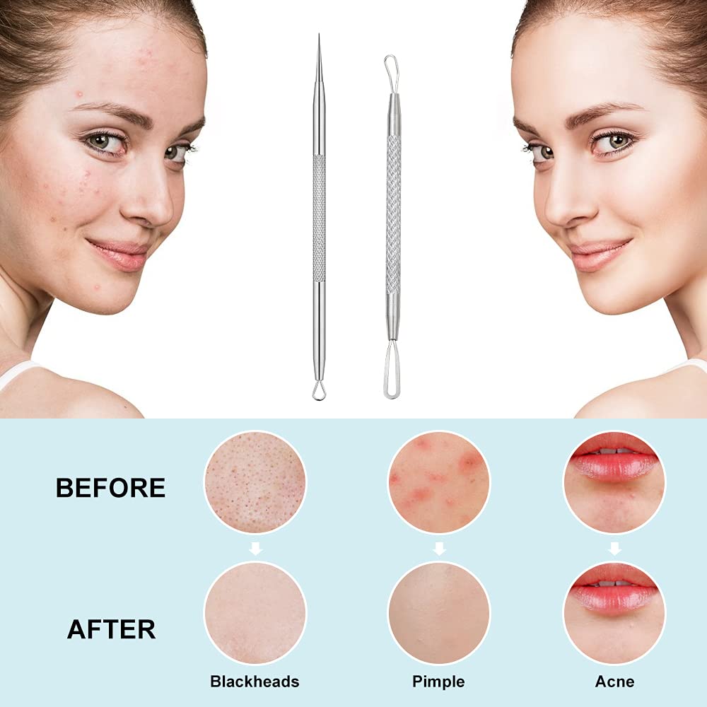 La Chat Blackhead Remover Tool Set - 2 PCS Stainless Steel Pimple Extractor, Risk-Free Treatment for Blemishes, Black