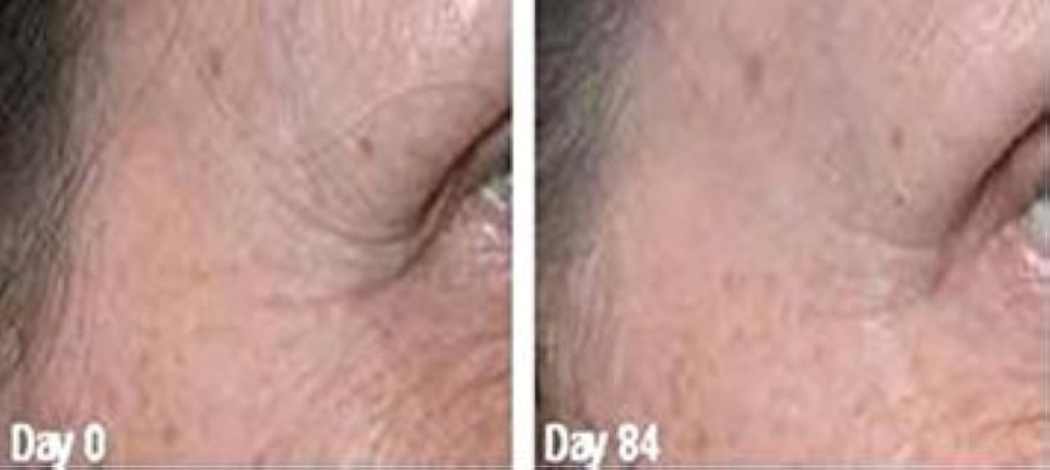 True Radiance JESSNER Peel 1 oz - Exfoliating Chemical Peel for Skin Resurfacing, Collagen Production & Hyperpigmentation Removal