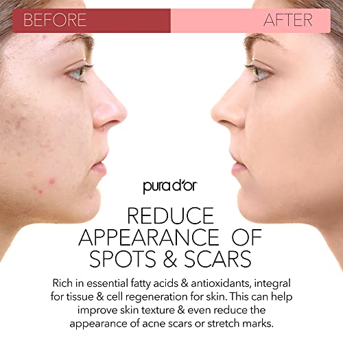 PURA D'OR Organic Scar & Stretch Mark Treatment Oil (1oz) For Skin - With Rosehip, Wheat Germ, Argan, Tamanu, Carrot, Rosemary,