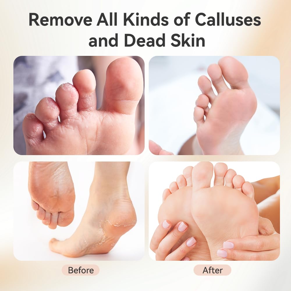 Callus Remover for Feet,Electric Foot Callus Remover with 80pcs Sandpaper Discs, 9 Speeds Pedicure Tools for Feet, Replacement S