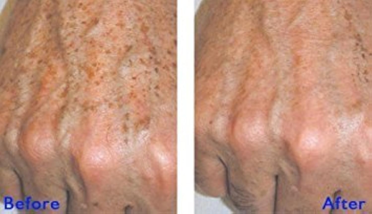 True Radiance JESSNER Peel 1 oz - Exfoliating Chemical Peel for Skin Resurfacing, Collagen Production & Hyperpigmentation Removal