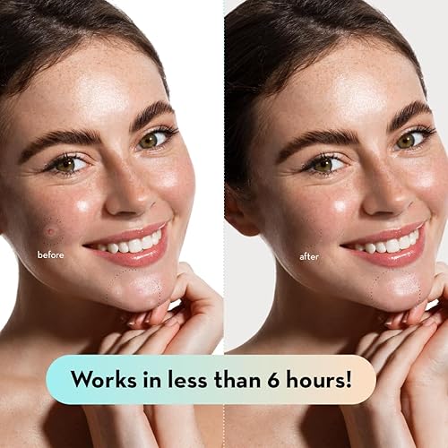 Le Gushe Pimple Patches For Face (132 Dots) - Hydrocolloid Acne Patch For Zits And Blemishes - Invisible Spot Cover Stickers For