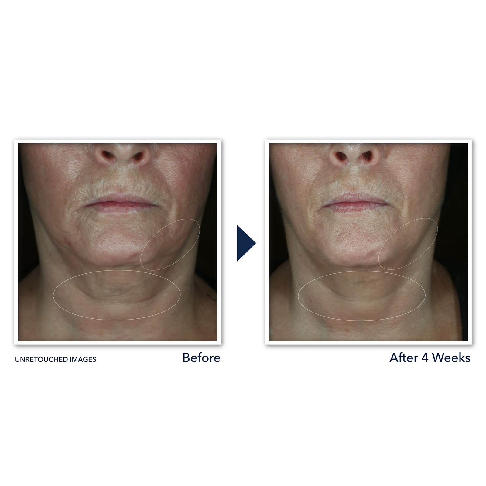 Roc Derm Correxion Neck Cream With Hyaluronic Acid And Advanced Retinol To Visibly Tighten & Lift Horizontal Neck Lines, Facial