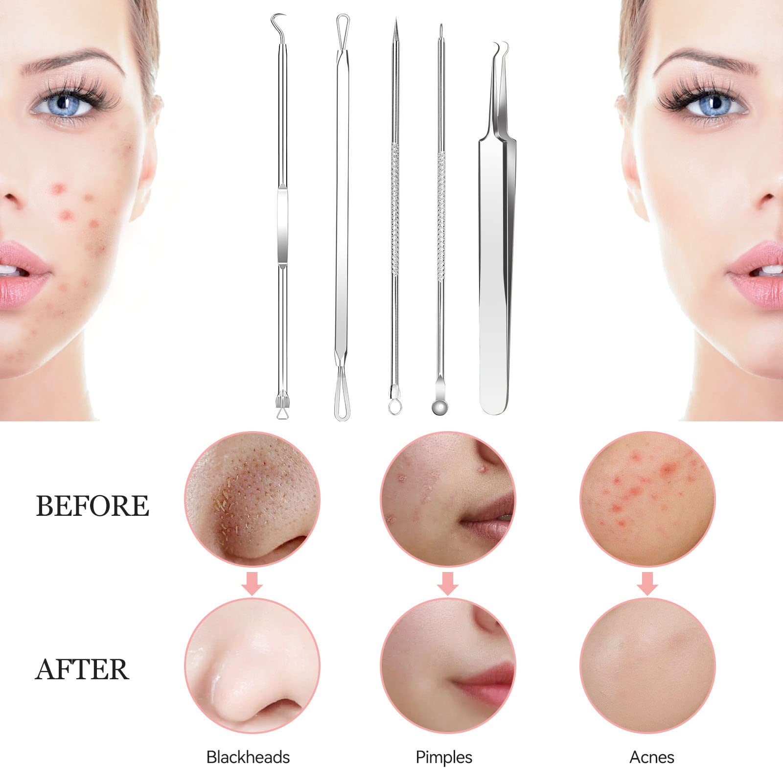 Whitehead Blemish Removal Tool Pimple Popper Tool Kit 8 Pcs Blackhead Remover
