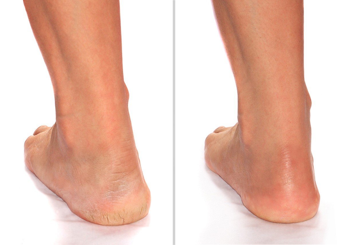 Advanced Clinicals Cracked Heel Foot Cream Skin Care Moisturizer Lotion For Feet W/Shea Butter | Helps Heal Cracked Skin, Rough