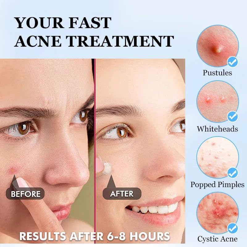 ClearPatch Acne Treatment Hydrocolloid Pimple Patch (36 Patches in 1 Box) - Invisible Acne Patch for Pimple, Blemish Healing, Sk