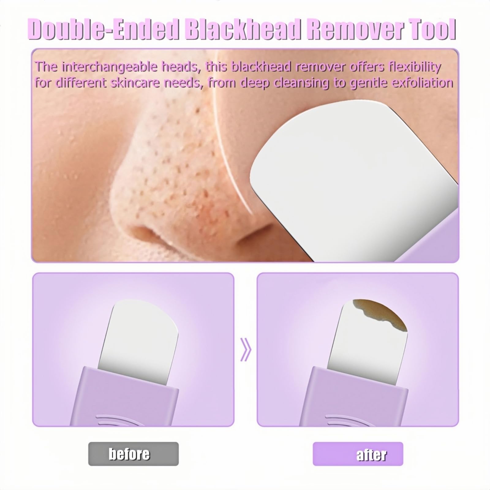 Blackhead Remover & Pimple Extractor Kit Dual-Ended Skin-Friendly Design for Sensitive Skin Professional Pore Cleanse & Acne Hom