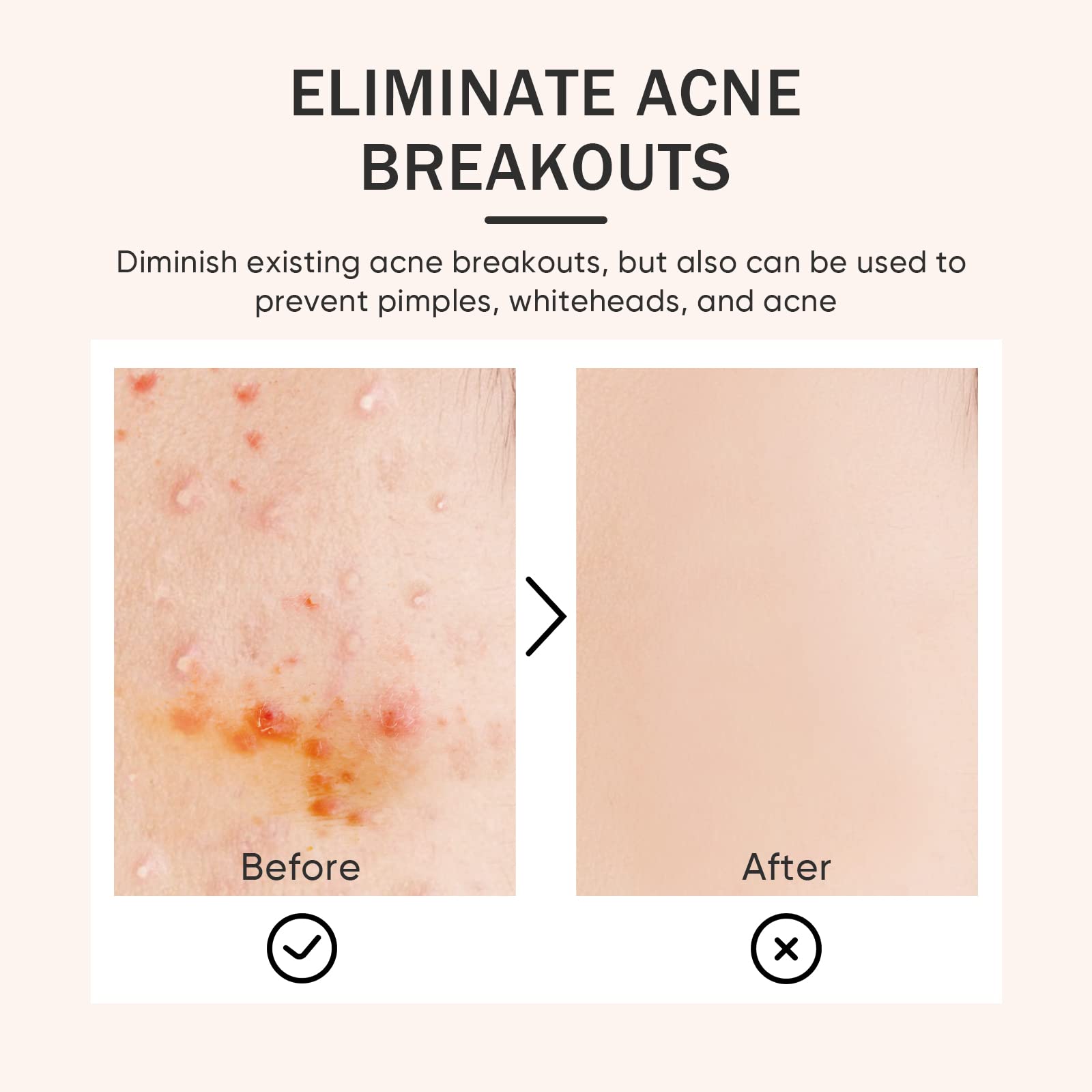 Tobcharm Butt Acne Clearing Treatment, Back Acne Treatment, Body Acne Treatment with Azelaic Acid 3.4 fl. oz., Great for Men and