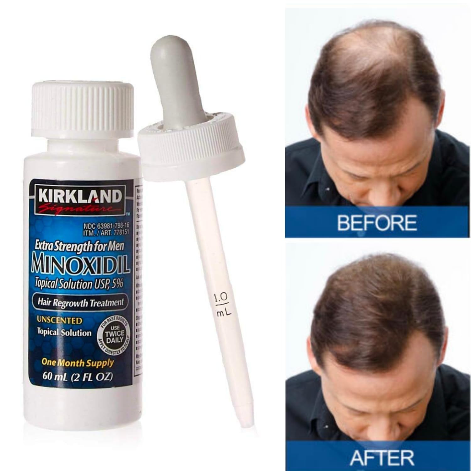 5% Minoxidil Topical Solution For Men - 6 Month Supply (6 X 2 Fl Oz), Hair Regrowth Treatment With Dropper, Cleaning Cloths & Tr