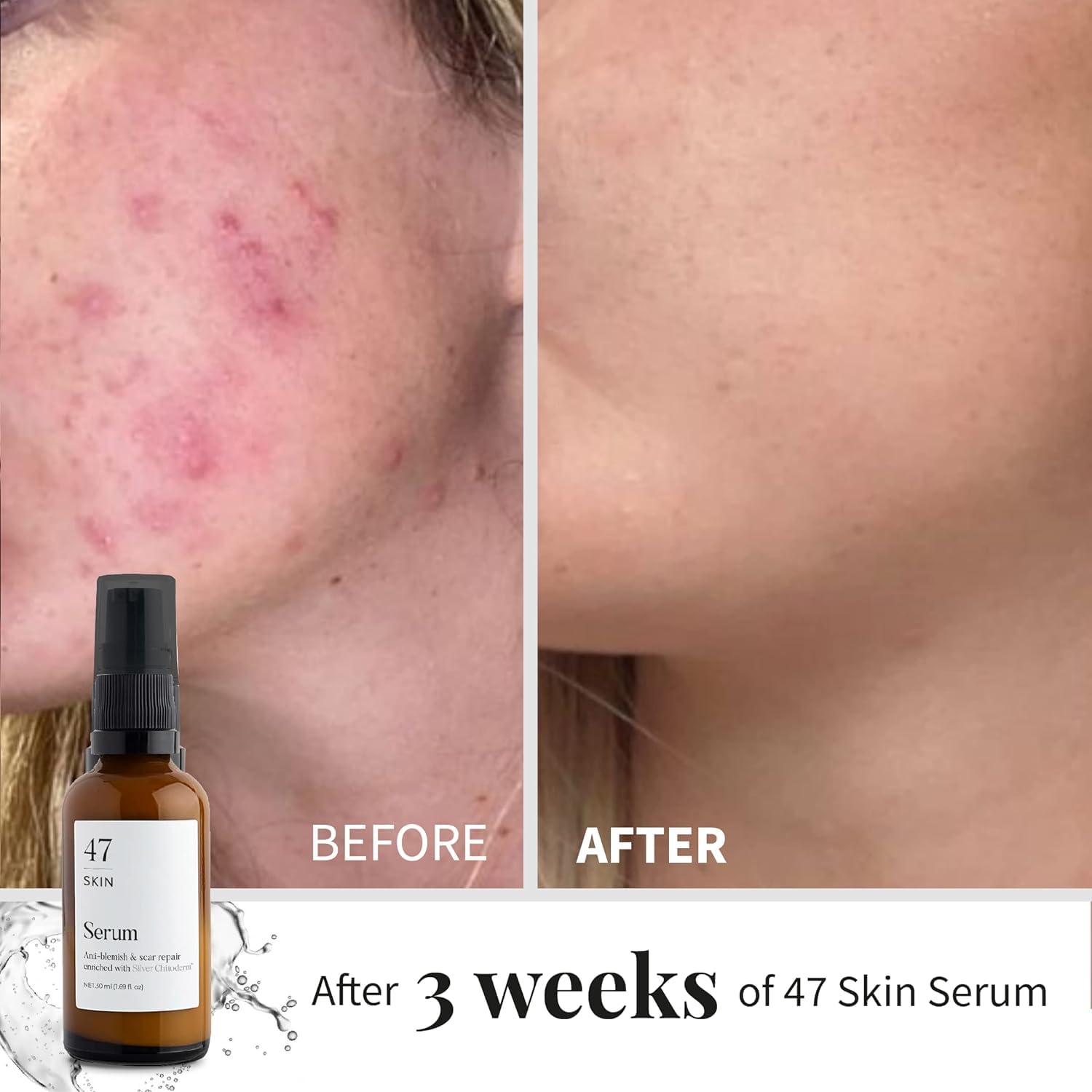 47 Skin Hydrating Face Serum for clearing Acne and Scars, Anti-Blemish & Scar Repair Serum Skincare Treatment with Silver chitod