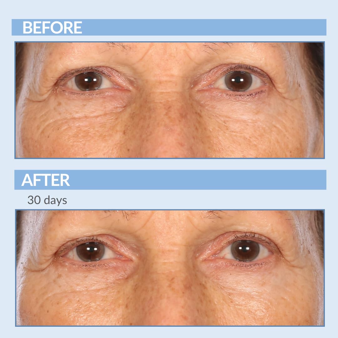 Serious Skincare - Retinol Vitamin A Eye XR Under Eye Cream Concentrate - Reduce Fine Lines, Dark Circles & Puffiness - Daily Wr