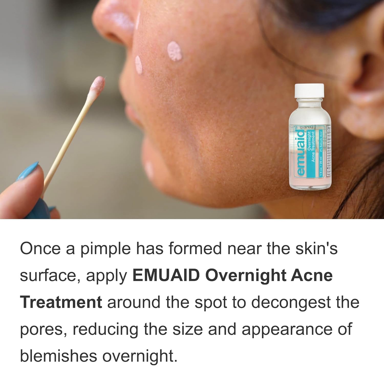 EMUAID Overnight Acne Treatment 1oz for stubborn blemishes, blackheads, cystic acne, and rosacea