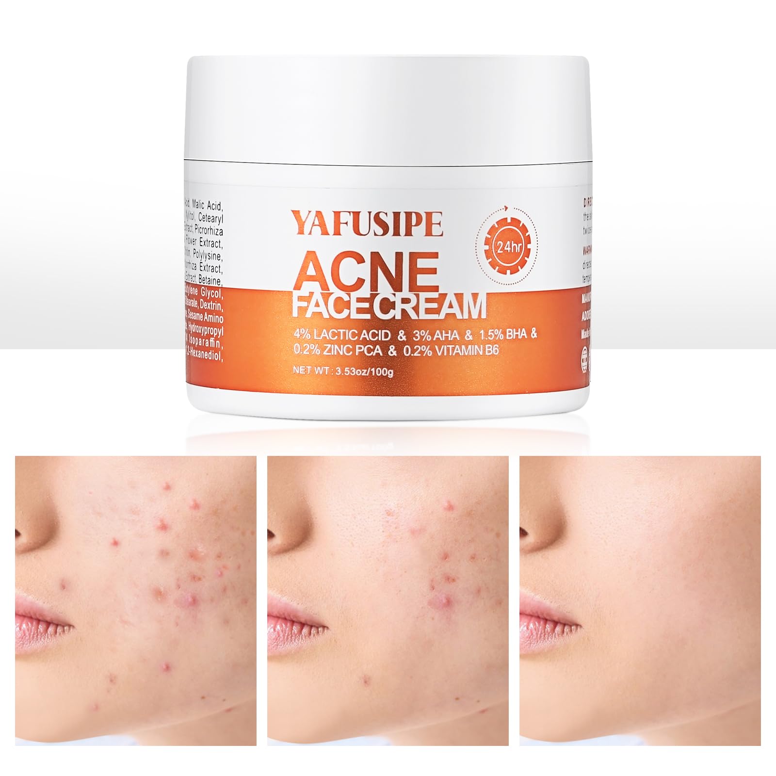 Acne Treatment for Face for Hormonal Cystic Stubborn Acne Cream for Sensitive Skin Teens Adults Women Men Spot Pimple Butt Contr