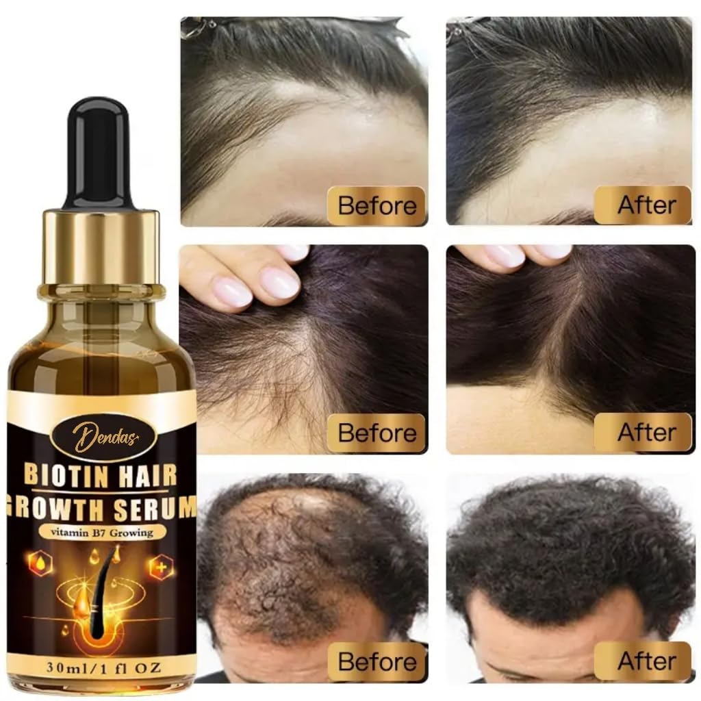 Dendas Biotin Hair Growth Serum - Anti-Hair Loss Essential Oil Treatment, Prevents Thinning, Repairs Dry & Frizzy Hair, Promotes