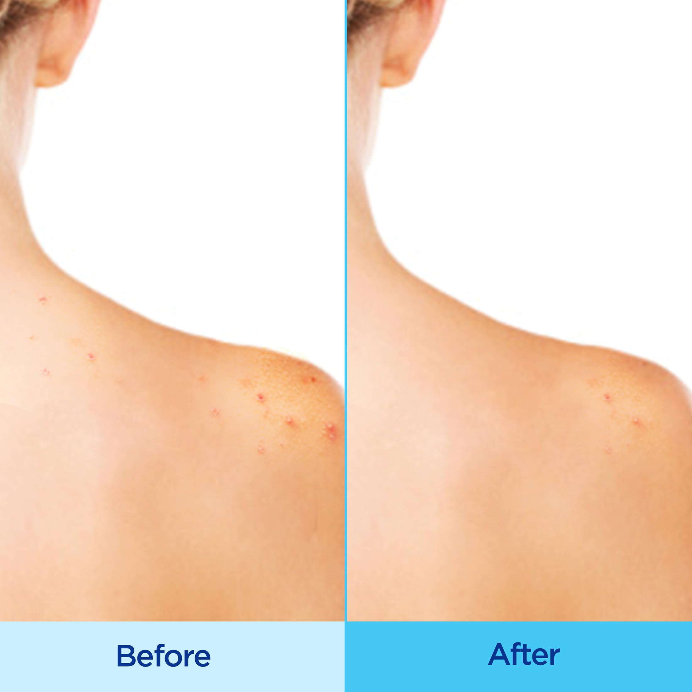 Differin Acne Body Spray, Acne Treatment with Salicylic Acid by the makers of Differin Gel, 360 Formula for Back Acne, Chest and