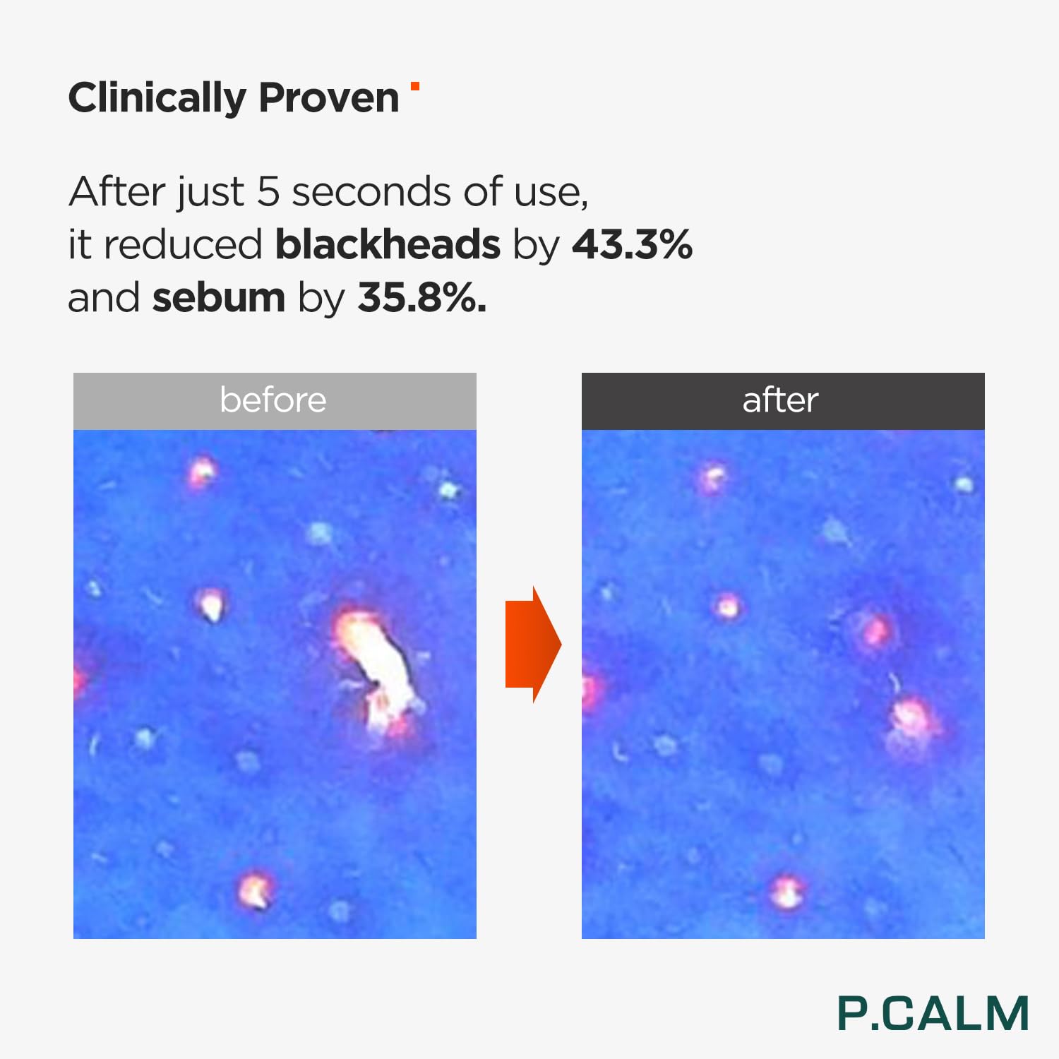 P.Calm Underpore Holy Basil Cleansing Oil 6.42 Fl.Oz | Instant Blackhead Reducing Non-Comedogenic Pore Control Cleansing Oil Wit