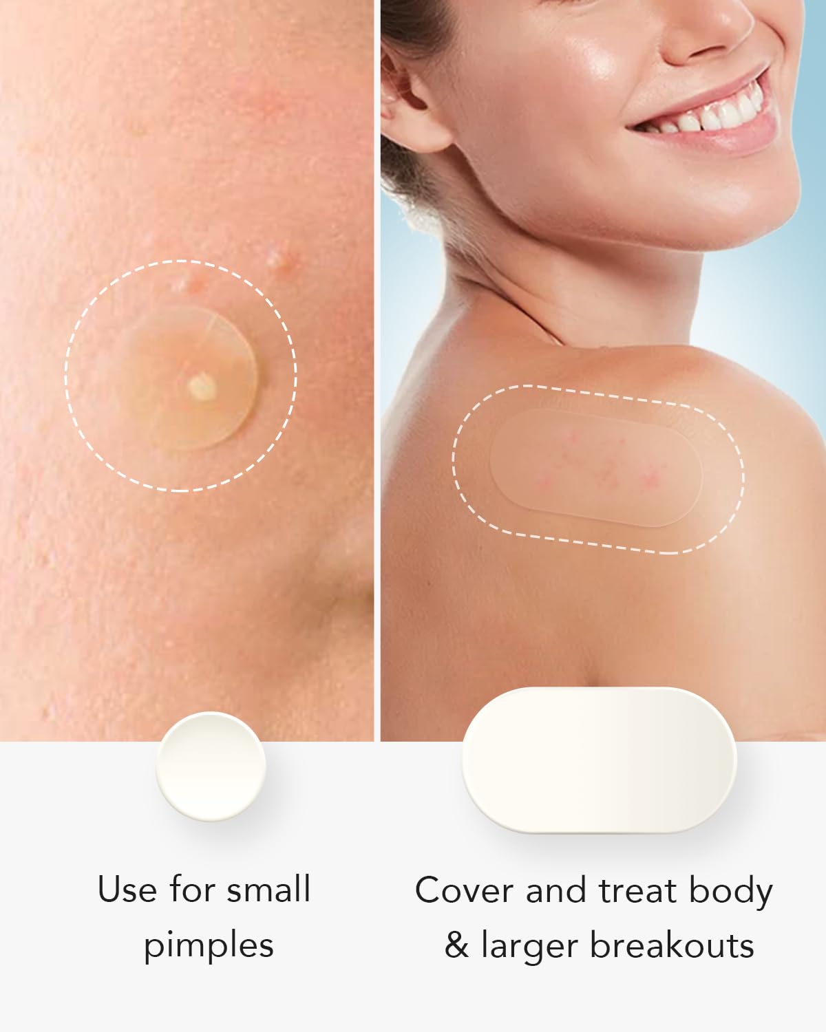 LitBear Large Pimple Patches - 80 Pieces, Reduces Inflammation, with Tea Tree & Calendula Oil, Transparent