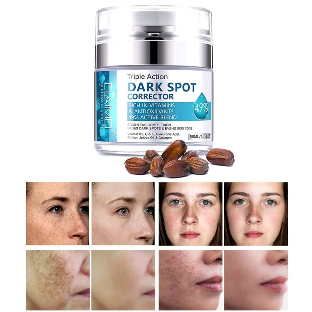 Swetiyou Dark Spot Remover For Face, Fast-Acting Dark Spot Corrector Remover For Face And Body Hyperpigmentation, Fades Melasma,