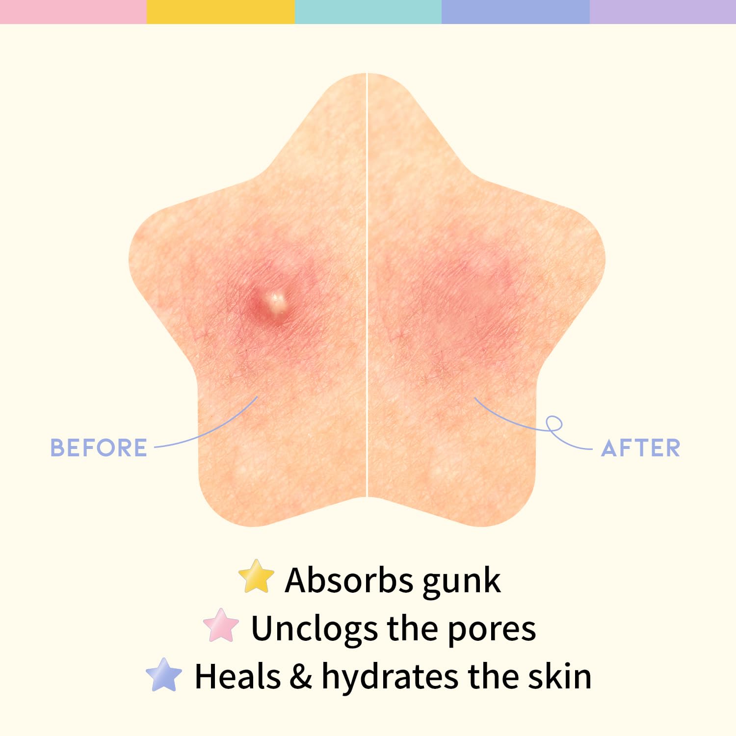 Star Spot Acne/Pimple Patch For Face, Hydrocolloid, Niacinamide, Ceramide, Cute Pastel Colors, Protecting & Healing, Prevent sca