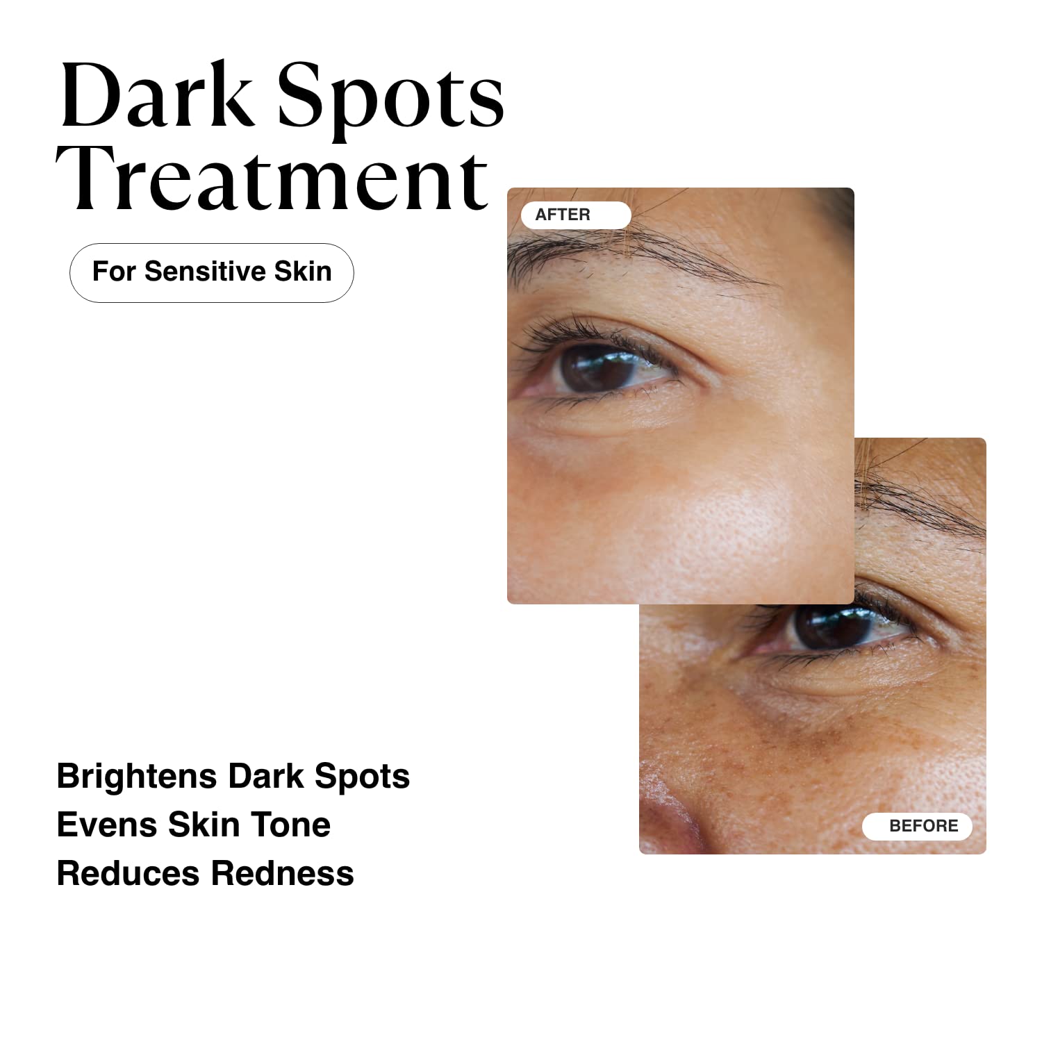 Matkas Korean Dark Spot Remover For Face Serum - For Uneven Skin Tone, Hyperpigmentation Treatment, Dark Spot Corrector, Discolo