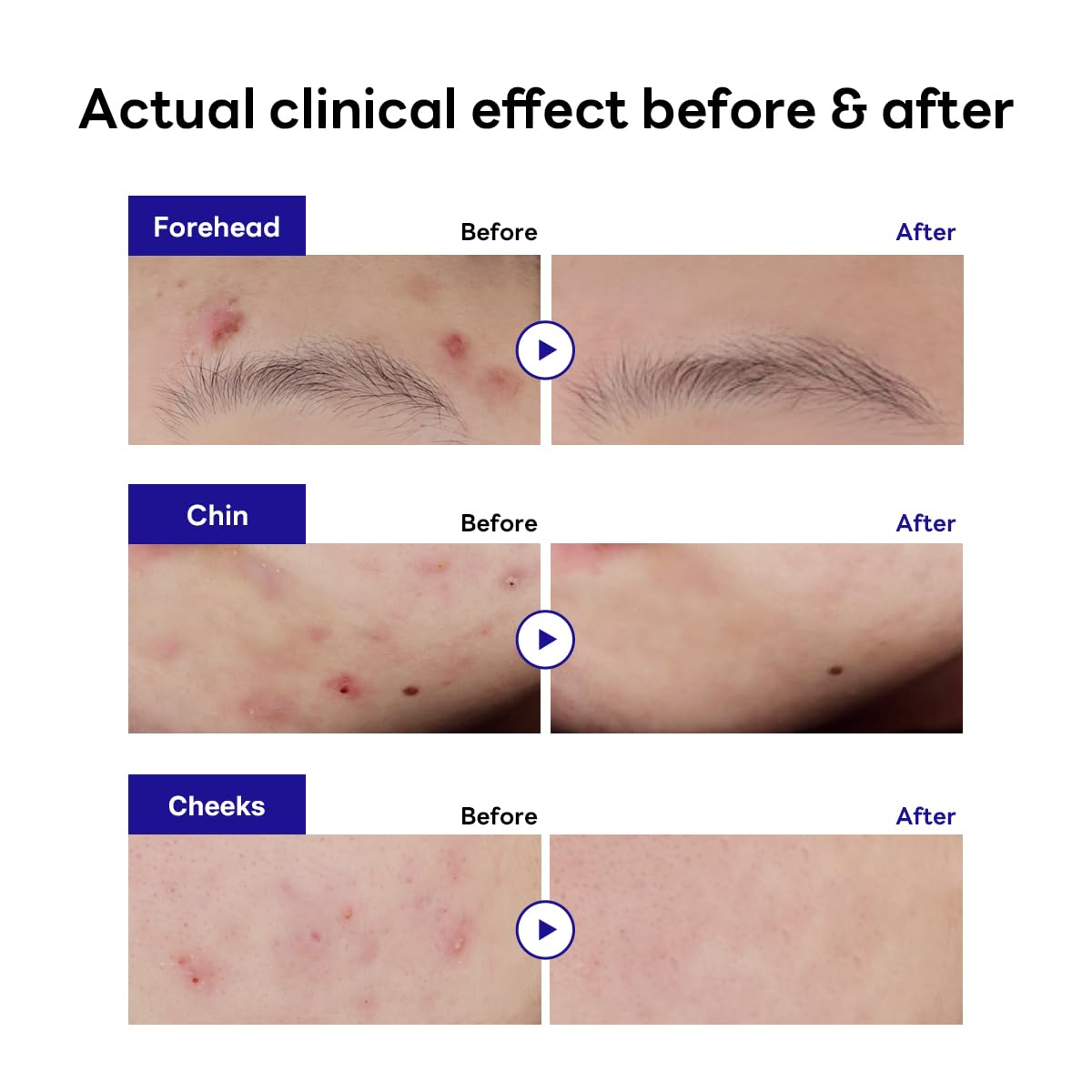 MEDIHEAL Derma Clear Teatree Treatment Spot Patch (44 Counts) - Acne Relief, Oil and Moisture Balance with Teatree & Salicylic A