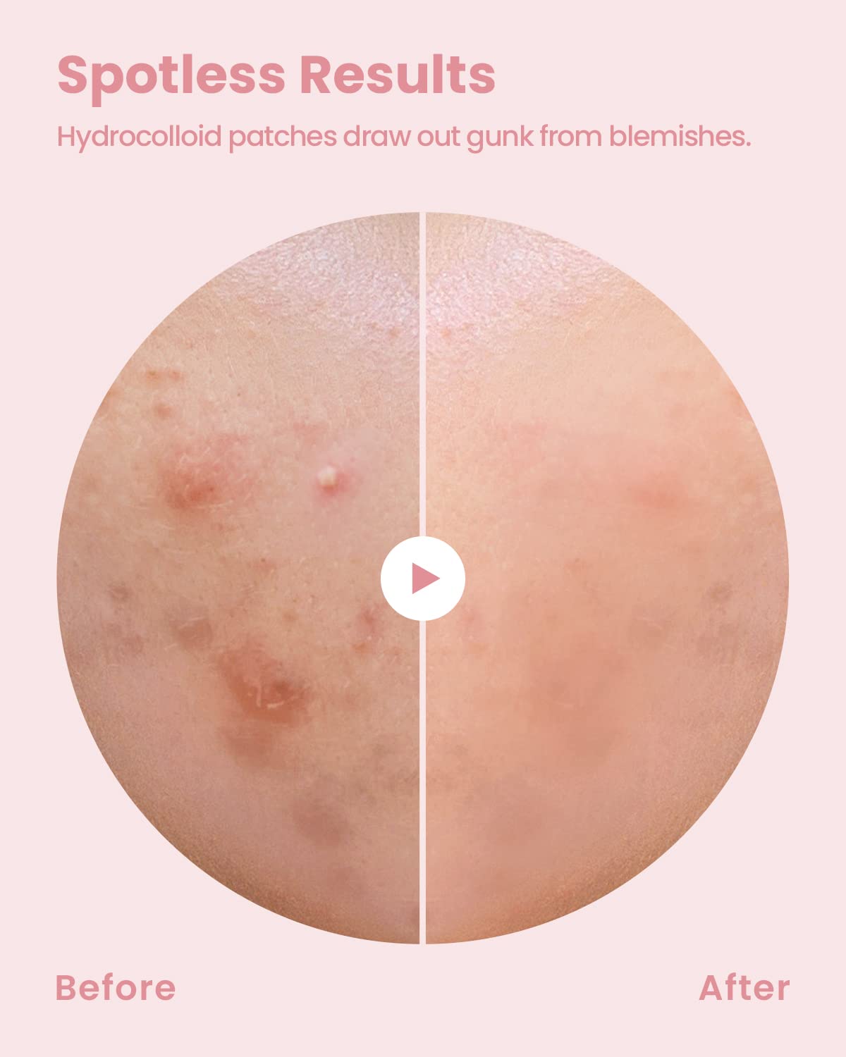 Glam Up Hydrocolloid Blemish Pimple Zit Patches - Invisible Ultra Thin Spot Cover Stickers For Face And Skin, Strong Water-Proof