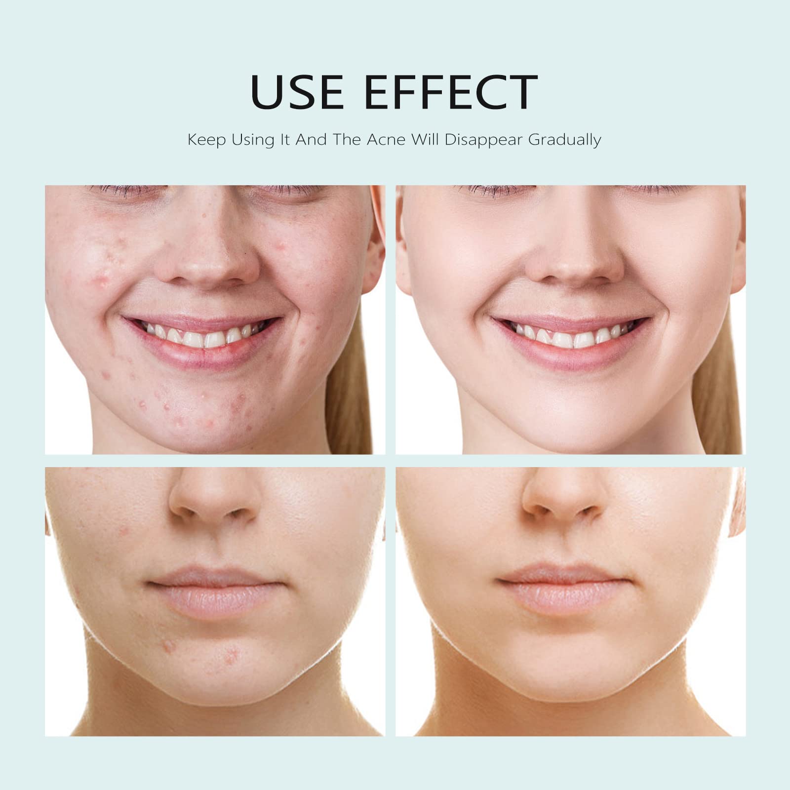 Facial Mask Anti Acne Face Mask Skin Care, Sheet Masks With Salicylic Acid Acne Sheet Mask For Acne Prone Skin Face Masks Skinca