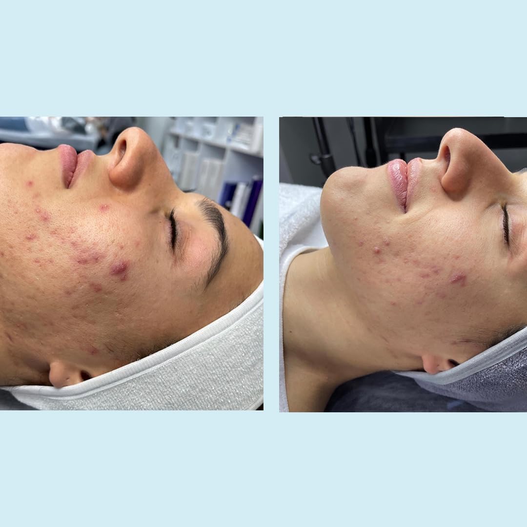 Salicylic Gel Chemical Peel - Enhanced With Green Tea Extract And Tea Tree Oil (20% Strength)