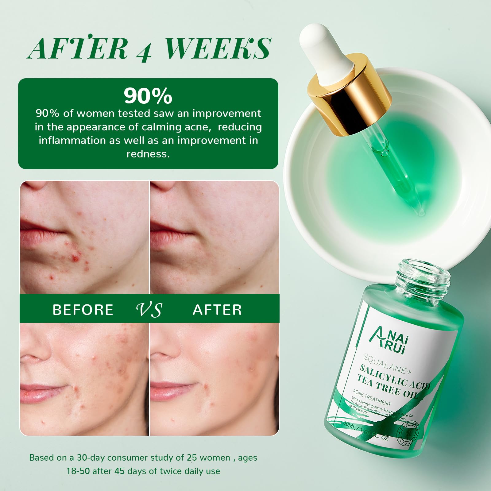 Anai Rui Acne Face Oil,Tea Tree Oil With Salicylic Acid,Acne Prone Skin Oil,Soothe Acne,Redness Relief, Tea Tree Oil For Face,Ba