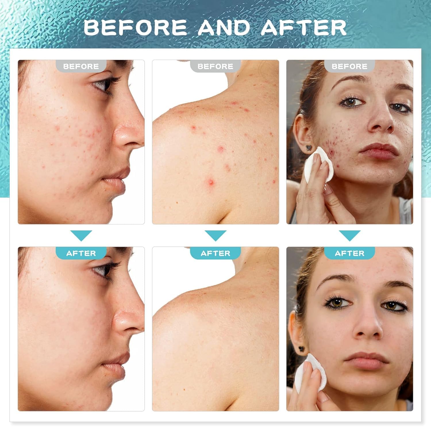 Paradise Emerald Acne Treatment for Face: Salicylic Acid Serum for Acne-Prone Men Women - Pimple Cream for Body Back