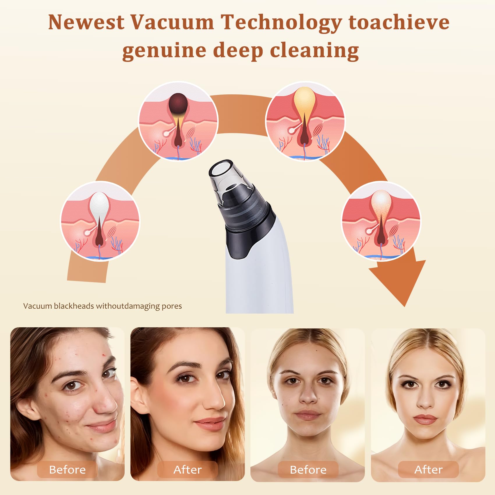 Blackhead Remover Vacuum - Powerful Pore Vacuum for Cleansing, Blackhead Extractor with 3 Adjustable Suction Levels, 4 Blackhead