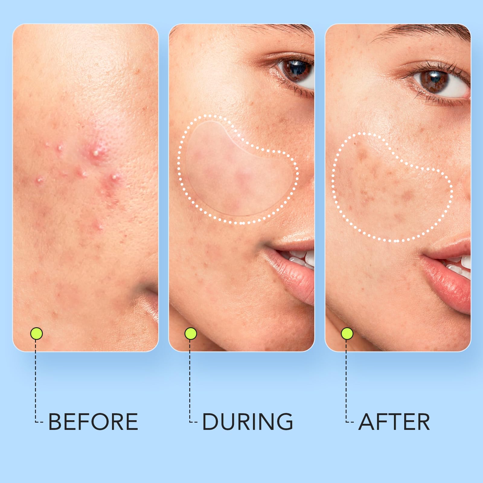 LitBear Large Pimple Patches (7 Sizes 112 Patches), Big Acne Patches, XL Hydrocolloid Bandages for Full Face, Forehead, Chin, No