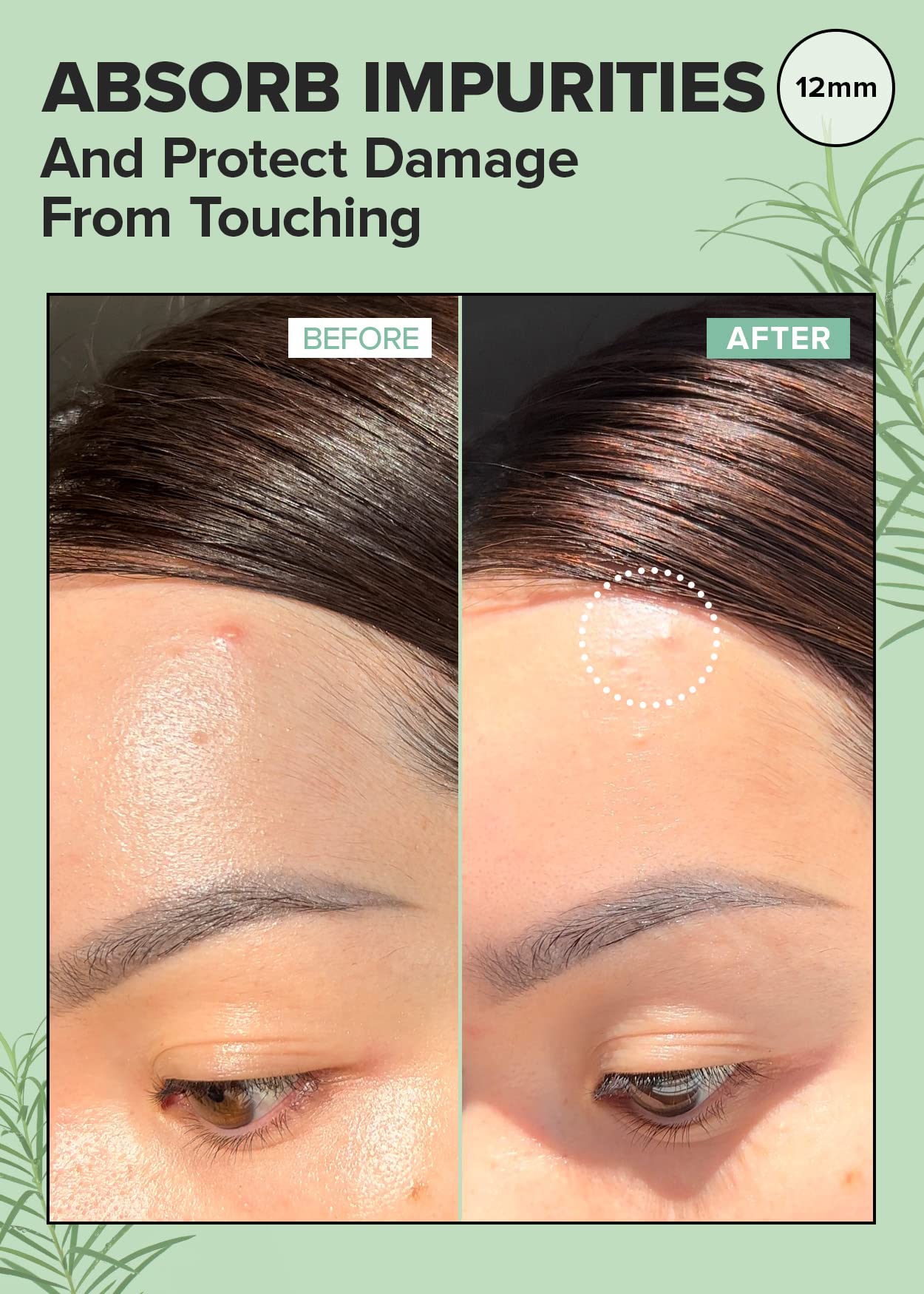 I Dew Care Hydrocolloid Acne Pimple Patch - Timeout Blemish Plus | Korean Zit Dark Spot Patches For Face And Skin, Large, 36 Cou