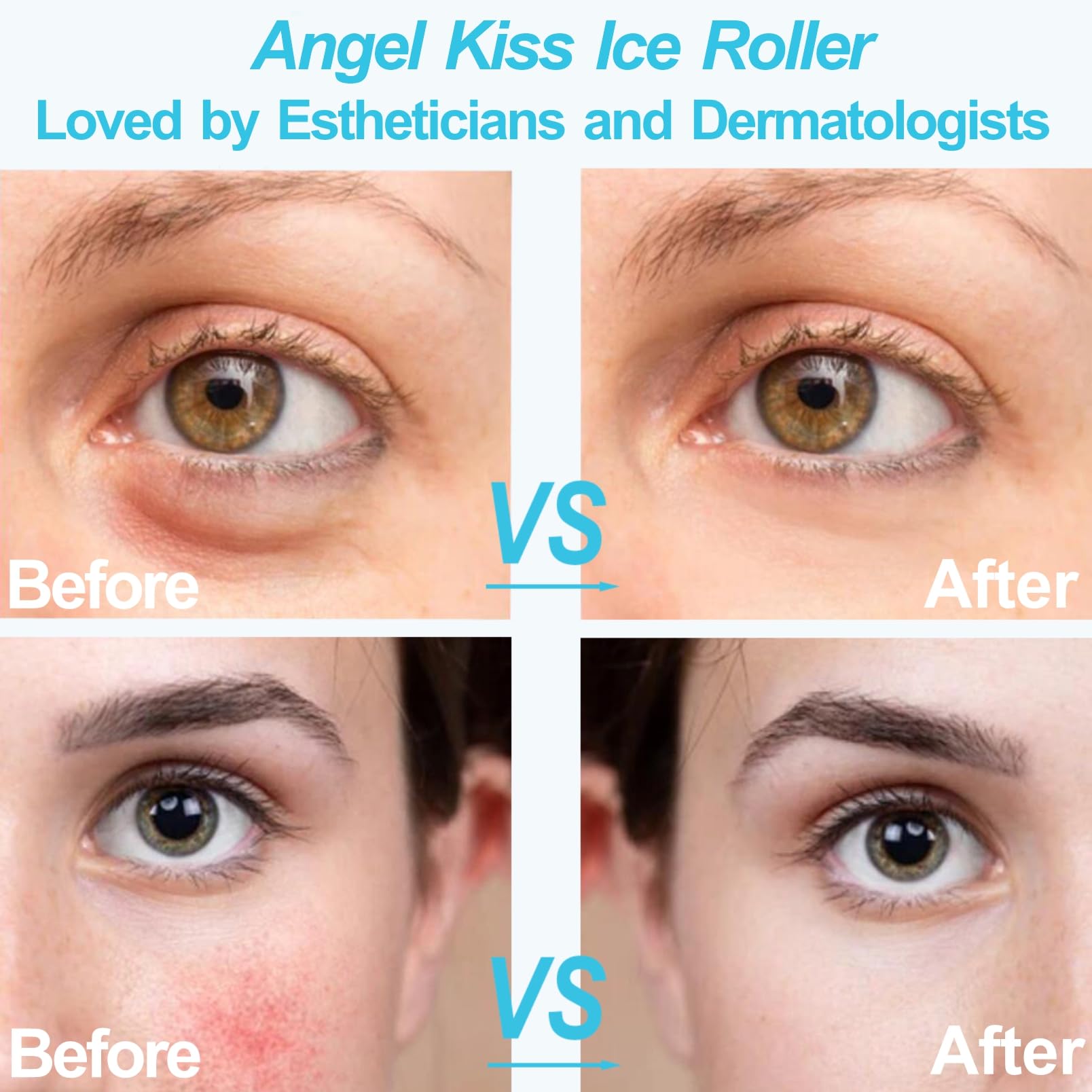 Angel Kiss Ice Roller For Face Eye, Women Gift Idea, Cold Therapy Massager For Reduce Puffiness, Redness, Dark Circles, Tighteni