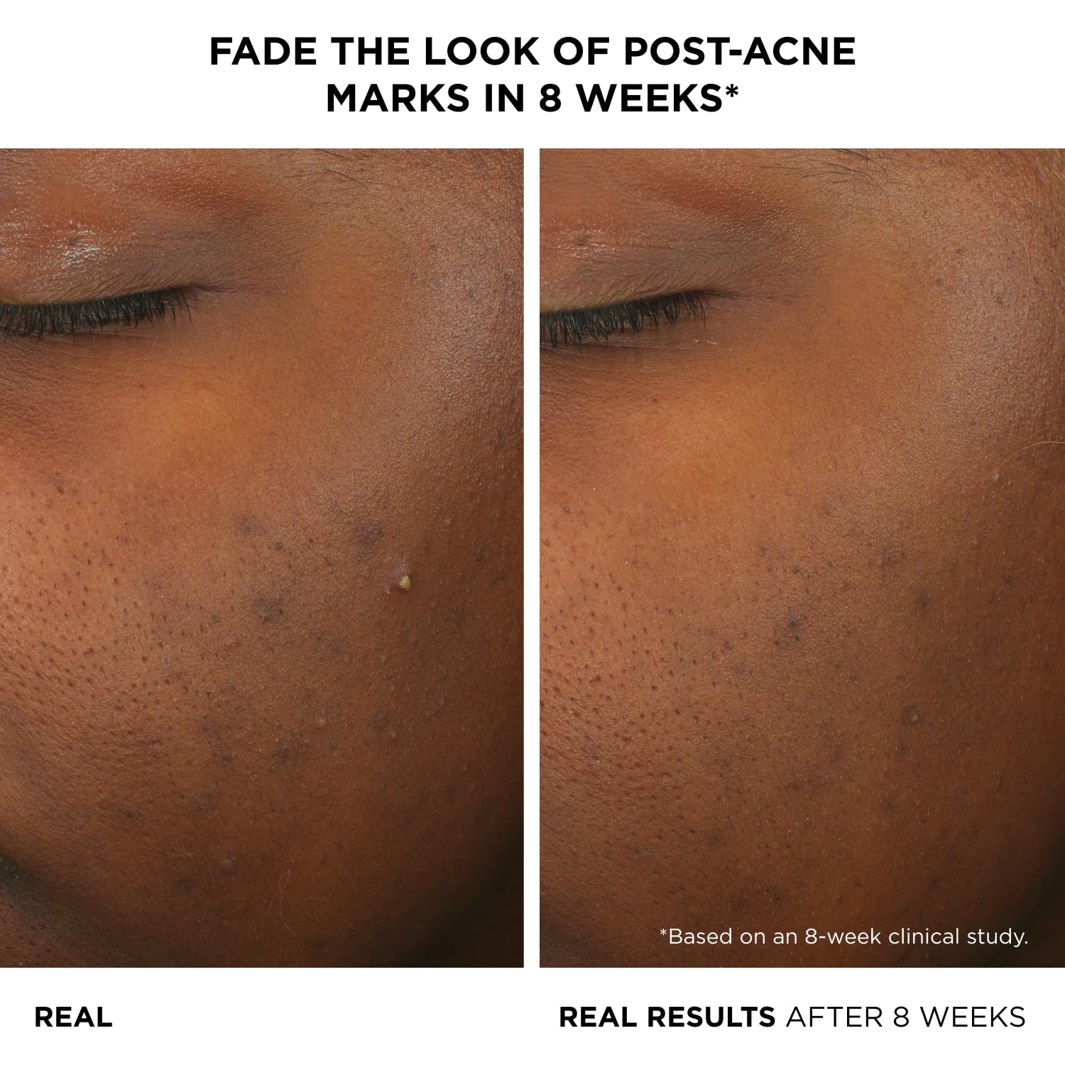 It Cosmetics Bye Bye Breakout 2% Salicylic Acid Acne Treatment Serum, Helps Reduce Pimples In 3 Days & Fades Look Of Post-Acne M