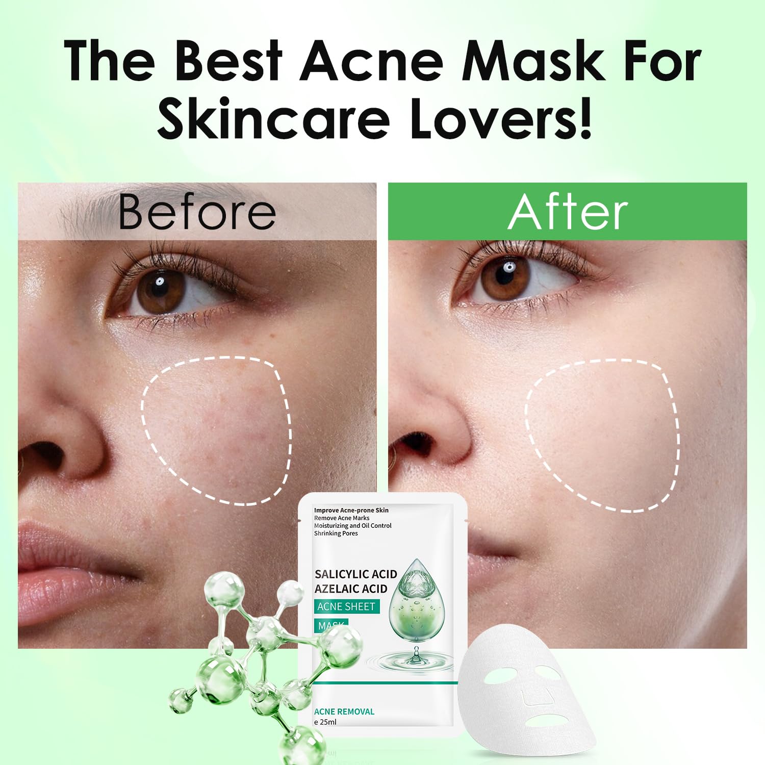 Irev Anti Acne Face Mask,Sheet Masks With Salicylic Acid, Face Masks Skincare For Acne, Acne Sheet Mask For Acne-Prone, Oily, An