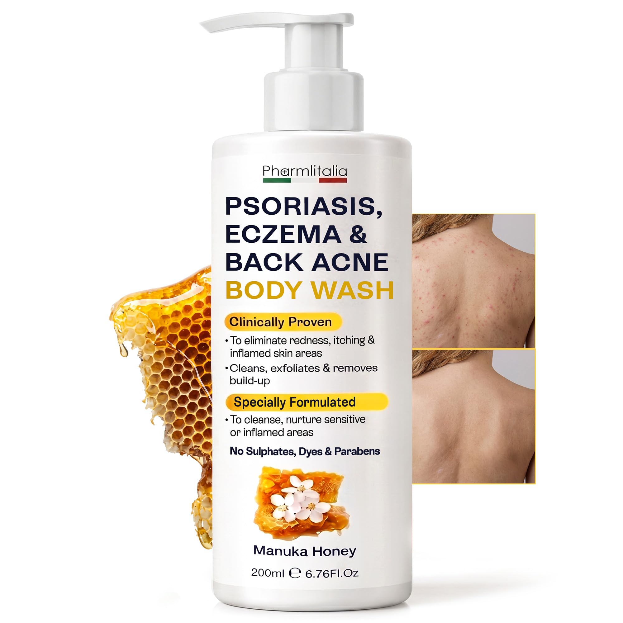 Pharmlitalia Psoriasis Body Wash for Sensitive Skin | Eczema & Back AcneProne Skin Cleanser | Soothes Redness, Scaling & Itchin