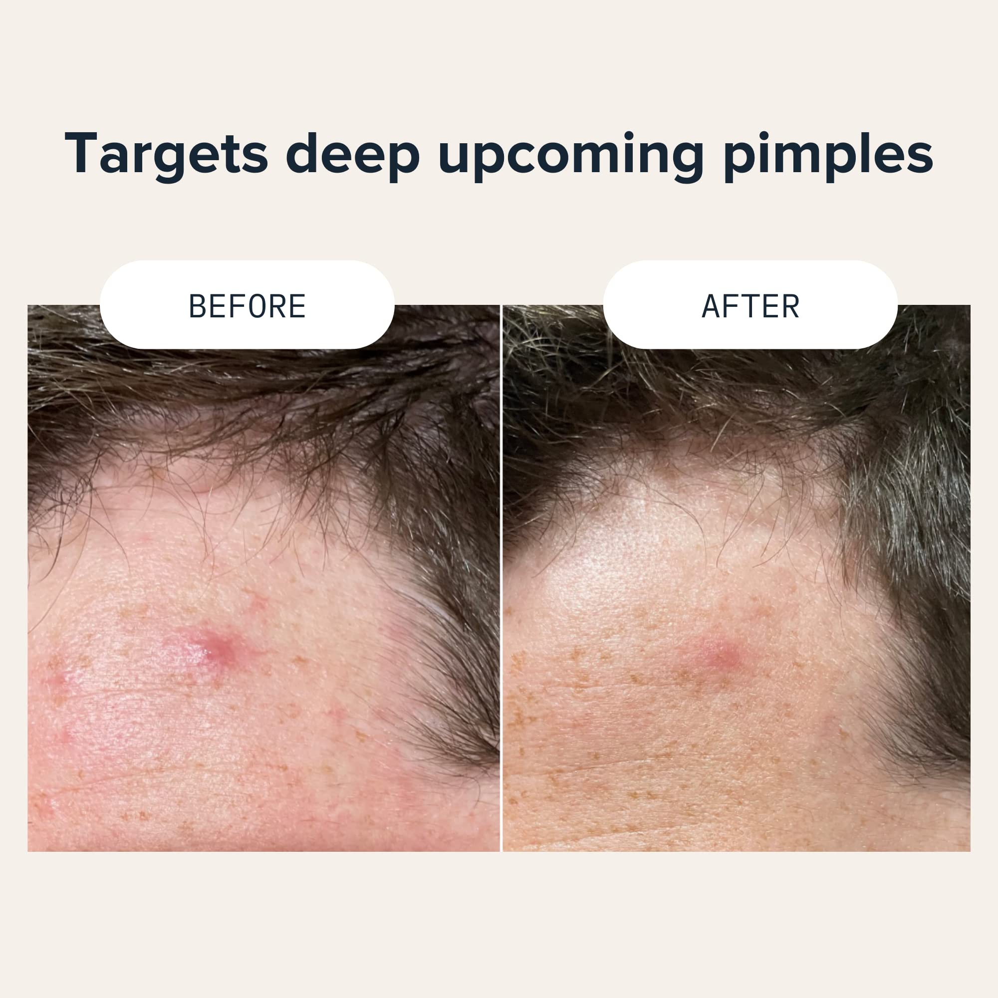 Cardon Prickly Pimple Patches, Spot Acne Treatment For Pimples, Blackheads, Zit Clearing Acne Patches, Salicylic Acid, 1-Step Fa