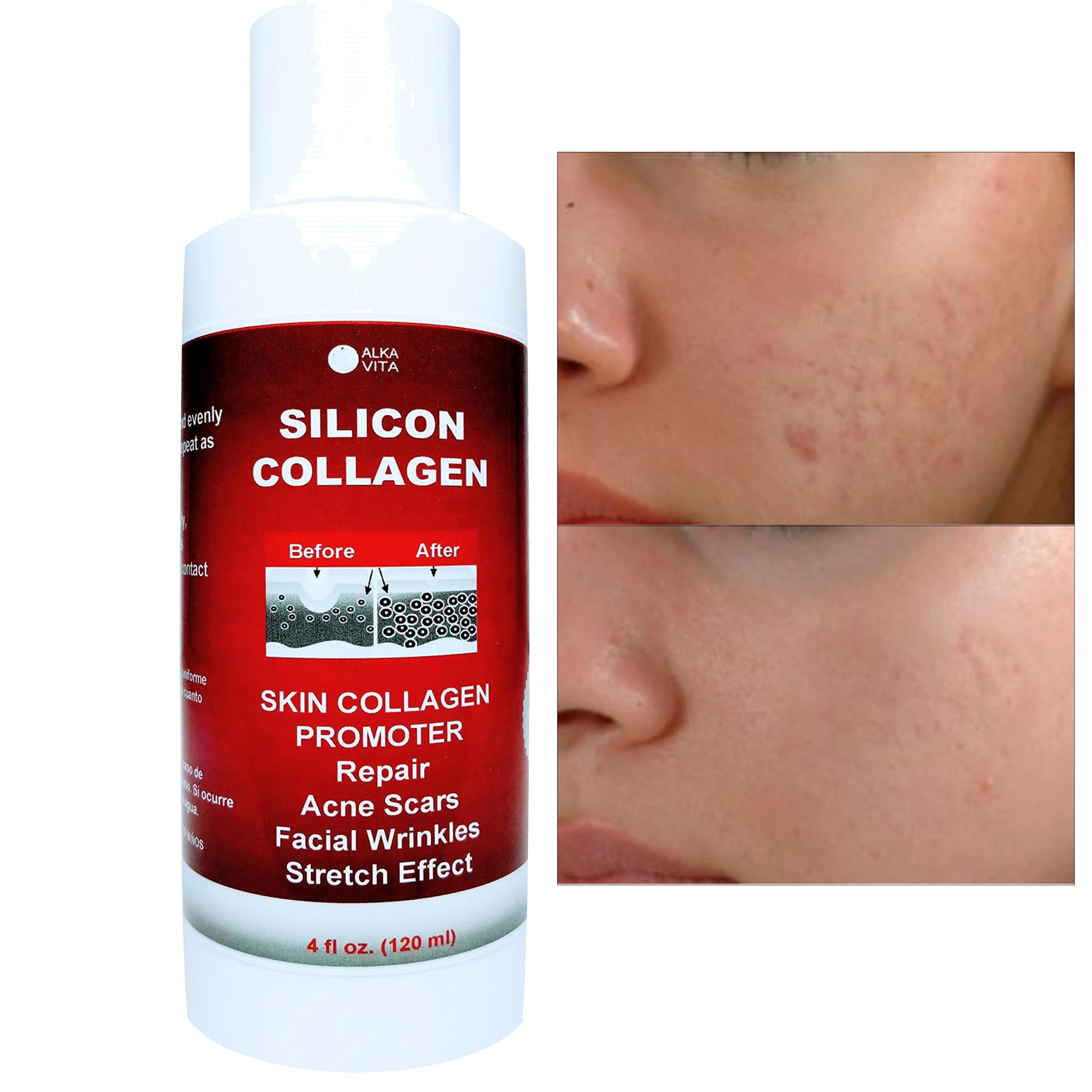 Skin Scars Silicon And Collagen Hydrolyzed Gel Resurfacing Skin Collagen Promoter For Indented Atrophic Rolling Face Scars By Al