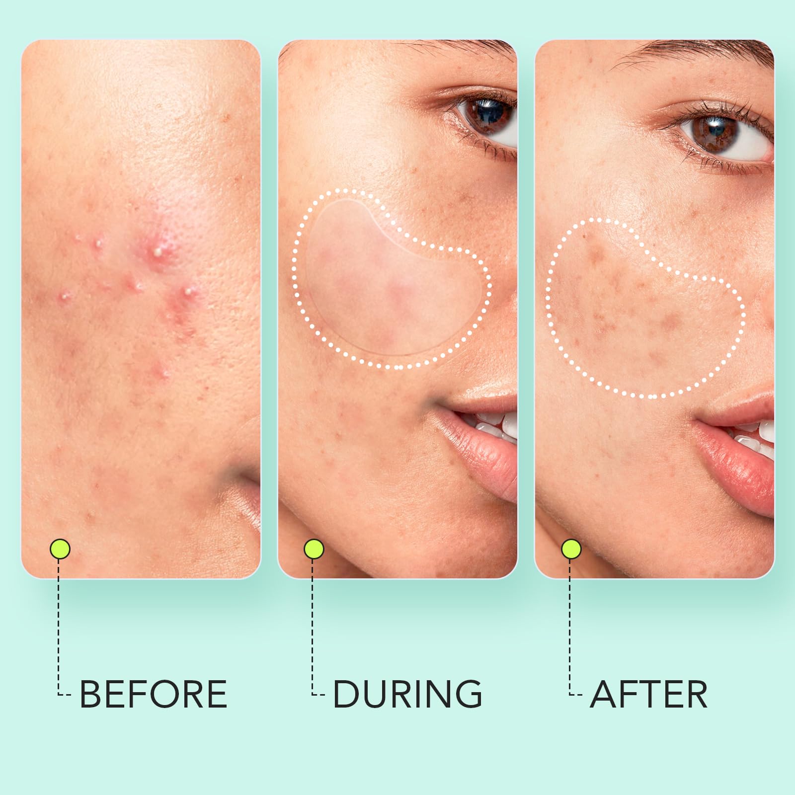 Litbear Large Pimple Patches (7 Sizes 306 Patches), Big Acne Patches, Xl Hydrocolloid Bandages For Full Face, Forehead, Chin, No