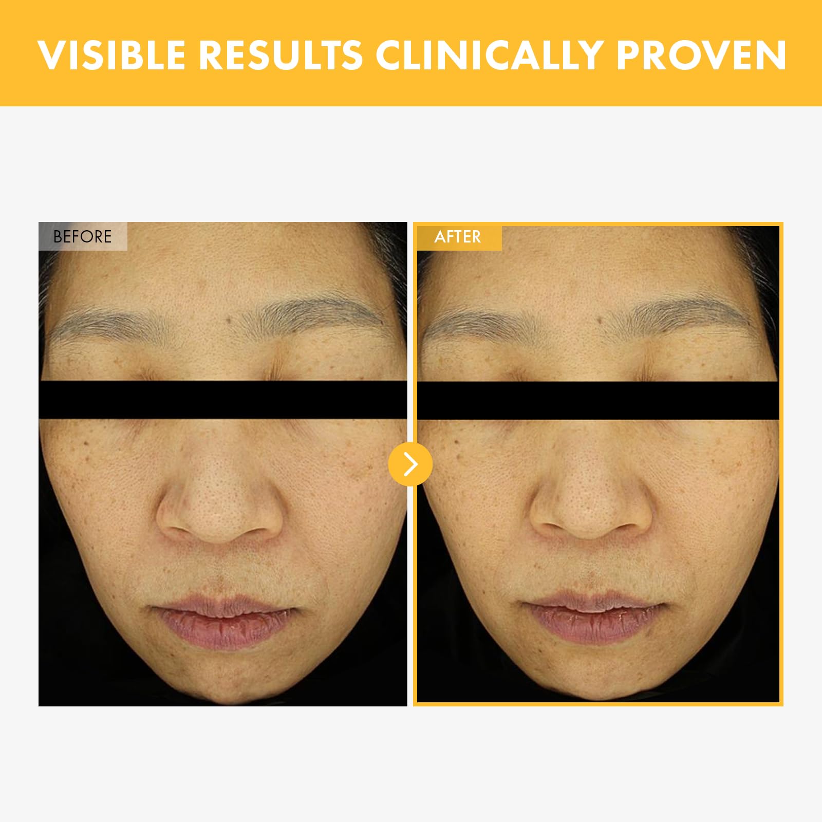 TOSOWOONG 8 Days Spot Cream, Dark Spot Remover for Face, Age Spot, Sun Spot, Freckles, Melasma, Brown Spot Serum, Advanced Formu