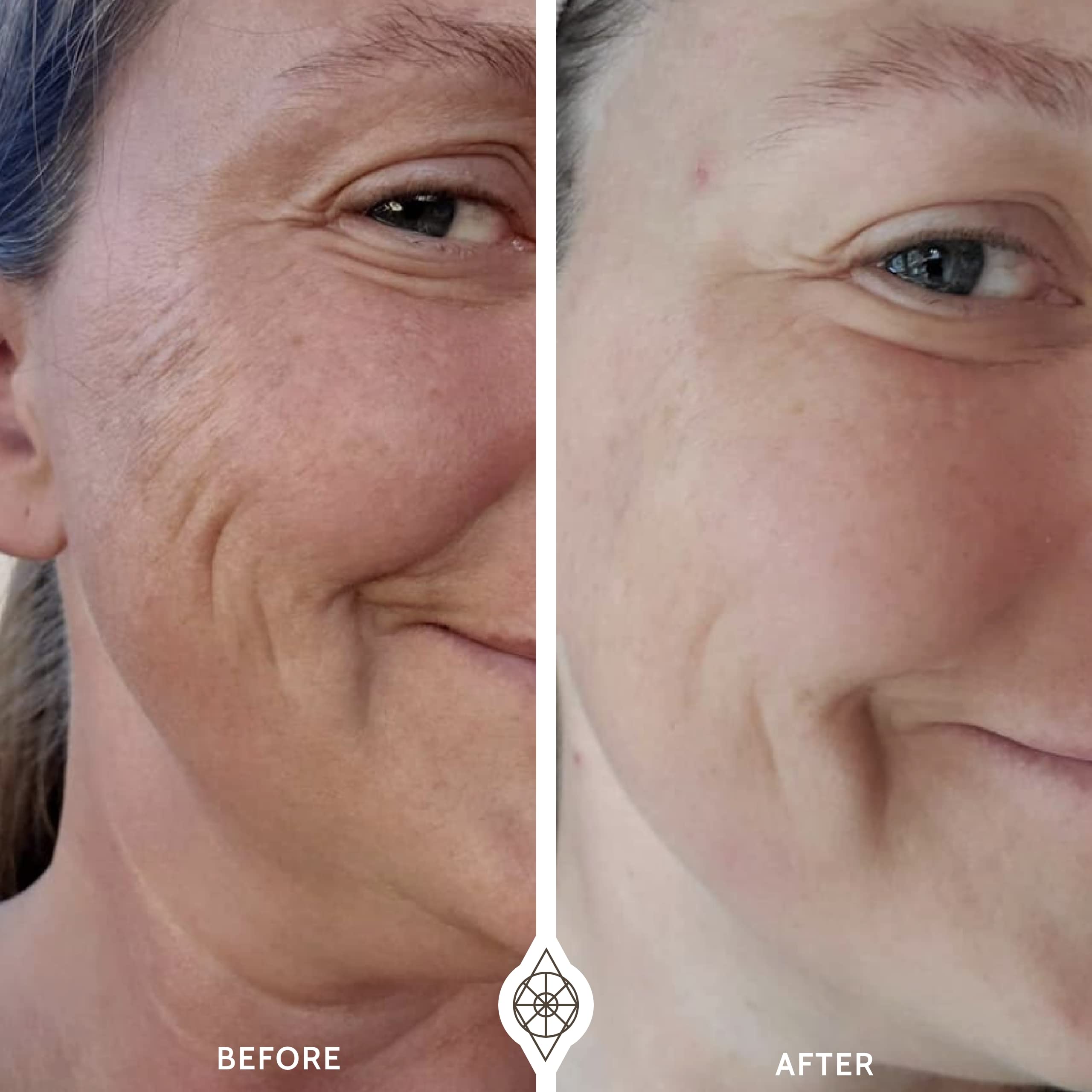 The Omg Blaster 5-In-1 Face Lifting Tool By Ashley Black. Patented Technology For Fine Lines, Wrinkles, Skin Tightening, Face Co