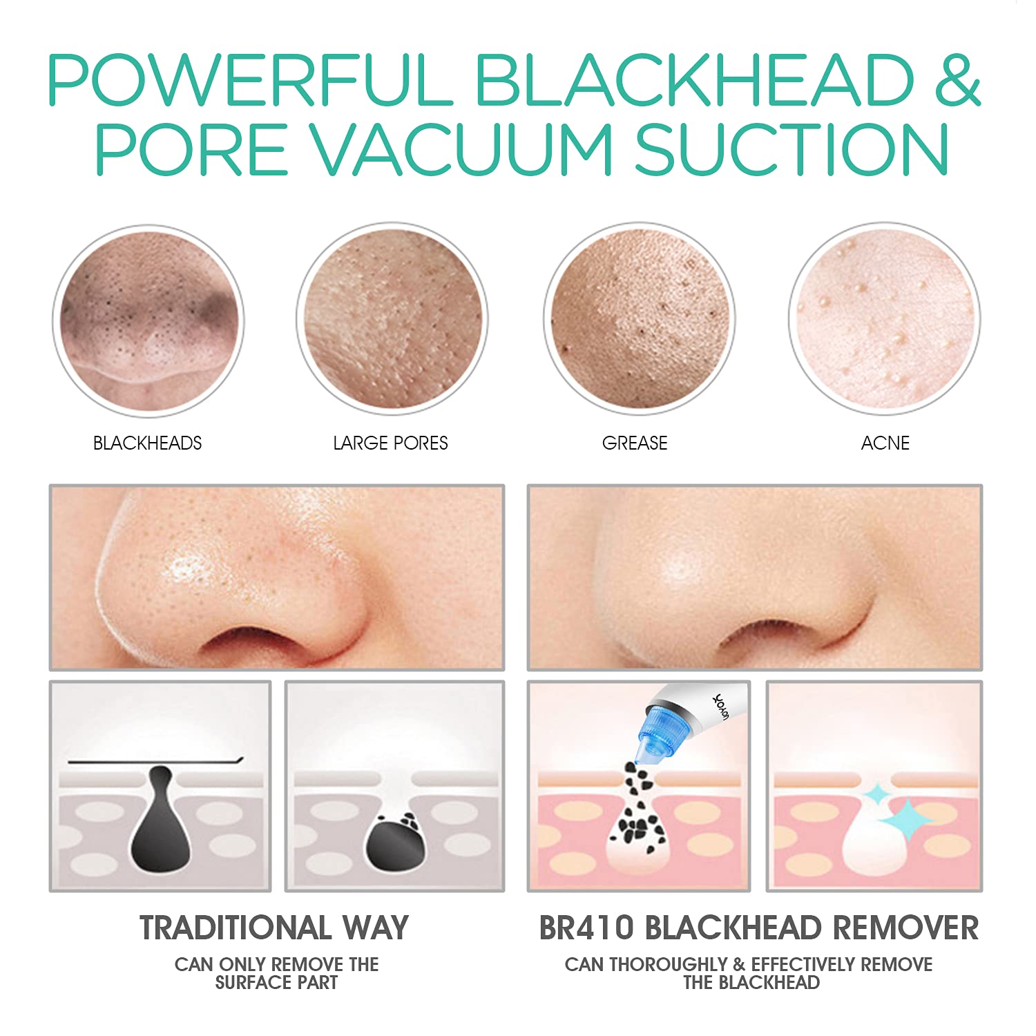 VOYOR Blackhead Remover Pore Vacuum - Electric Face Vacuum Pore cleaner Acne White Heads Removal with 6 Suction Heads BR410