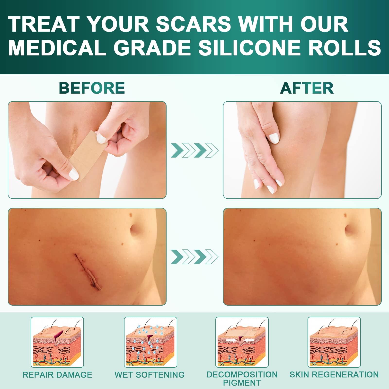 Silicone Scar Sheets,Silicone Scar Tape(16X 120 Roll-3M), Reusable And Effective Scar Removal Sheets, Silicone Scar Removal Shee